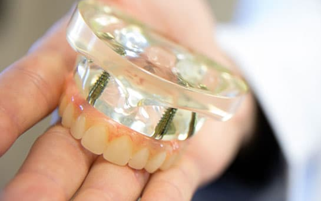 full arch dental implants