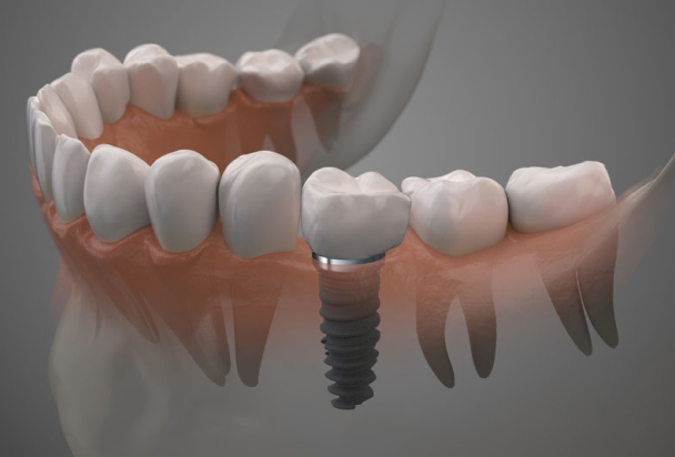 dental implant 3d render