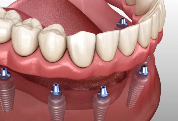all on 4 dental implants