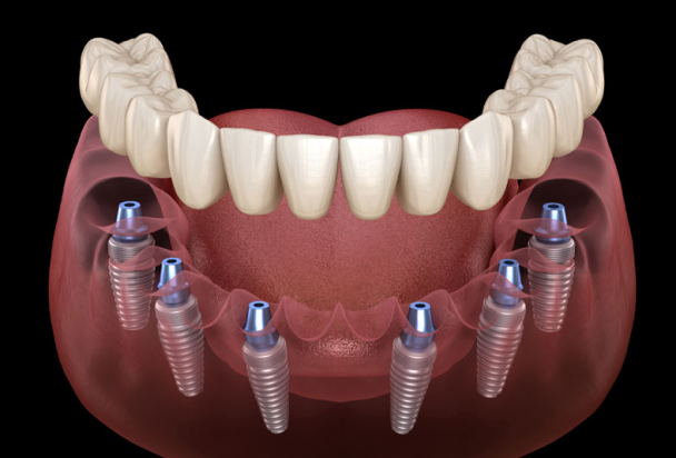 all on 4 dental implants