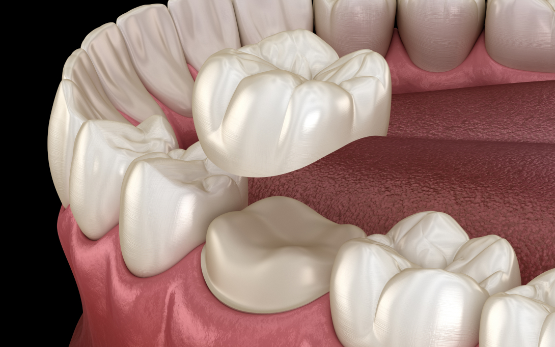 dental crown