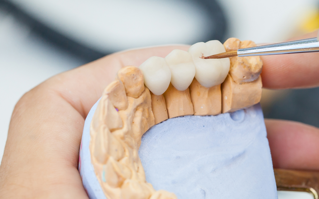 dental bridge