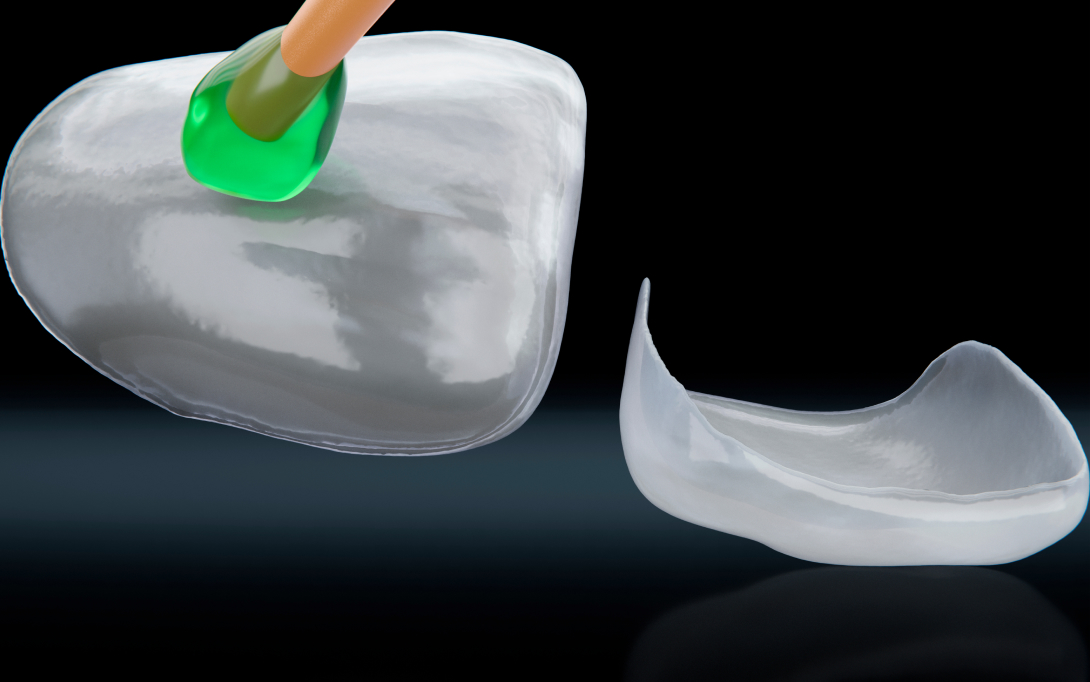 porcelain veneers process