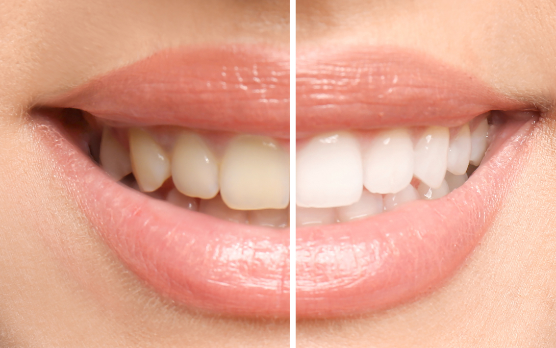 before and after teeth bleaching