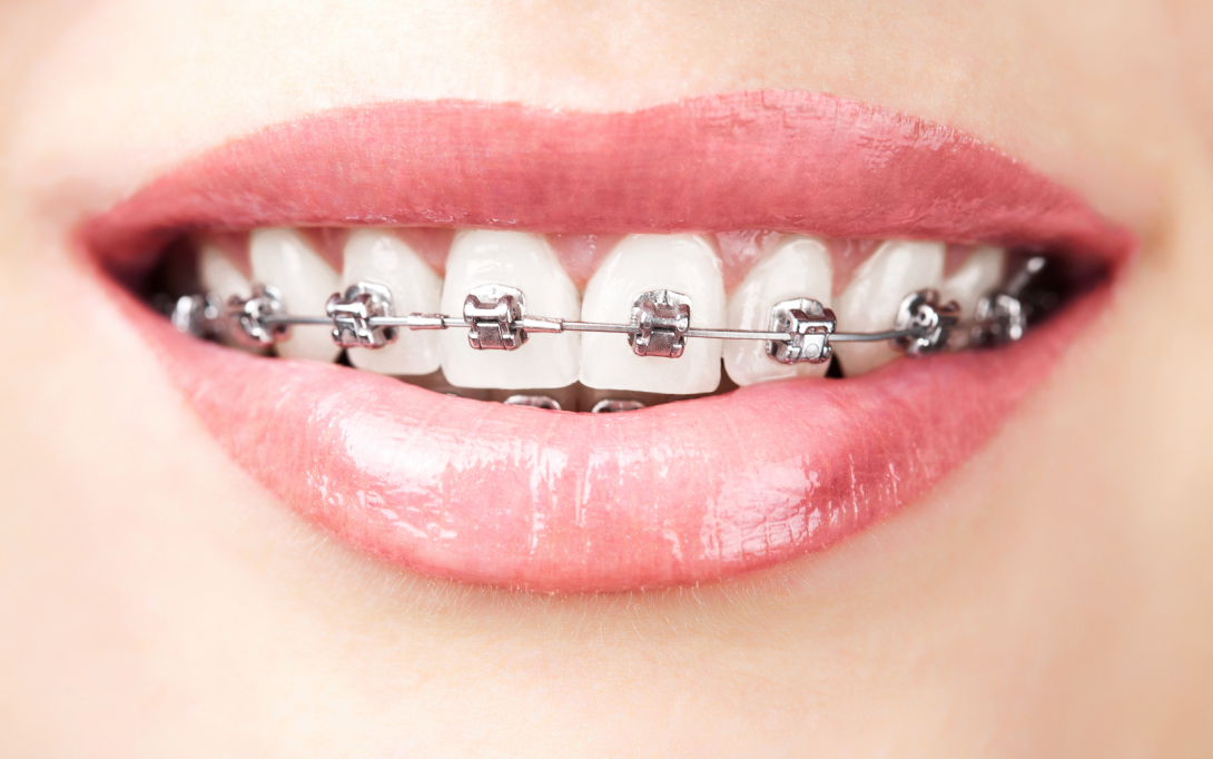 dental patient with braces