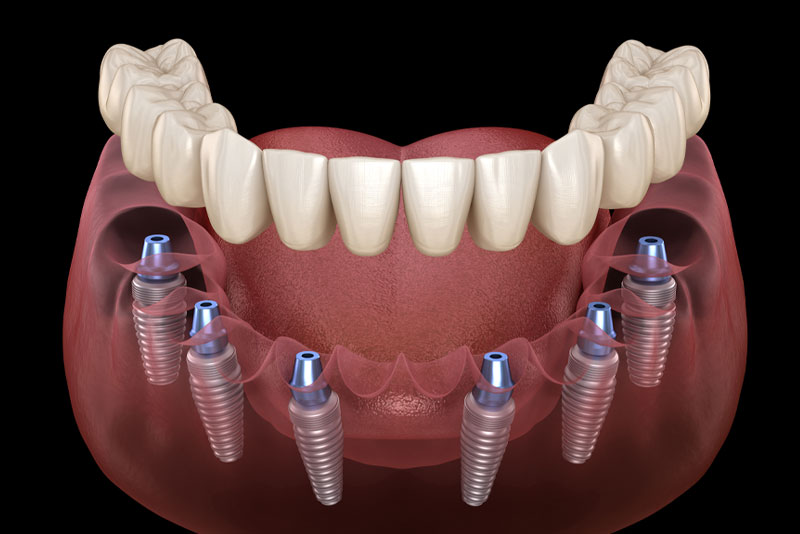 all on 4 dental implants