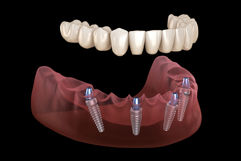 all on 4 dental implants