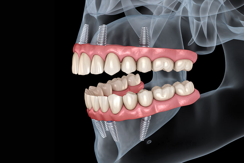 all on 4 dental implants