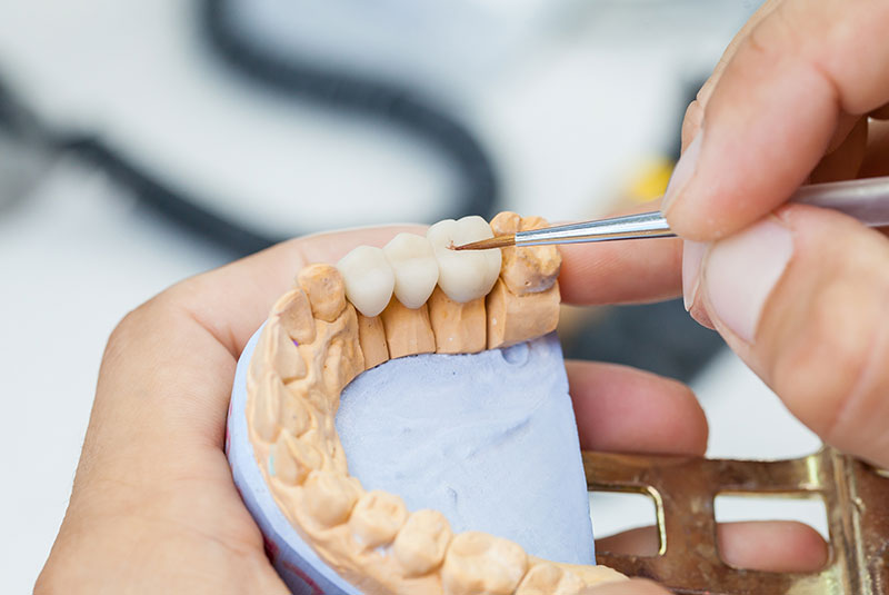 dental bridge