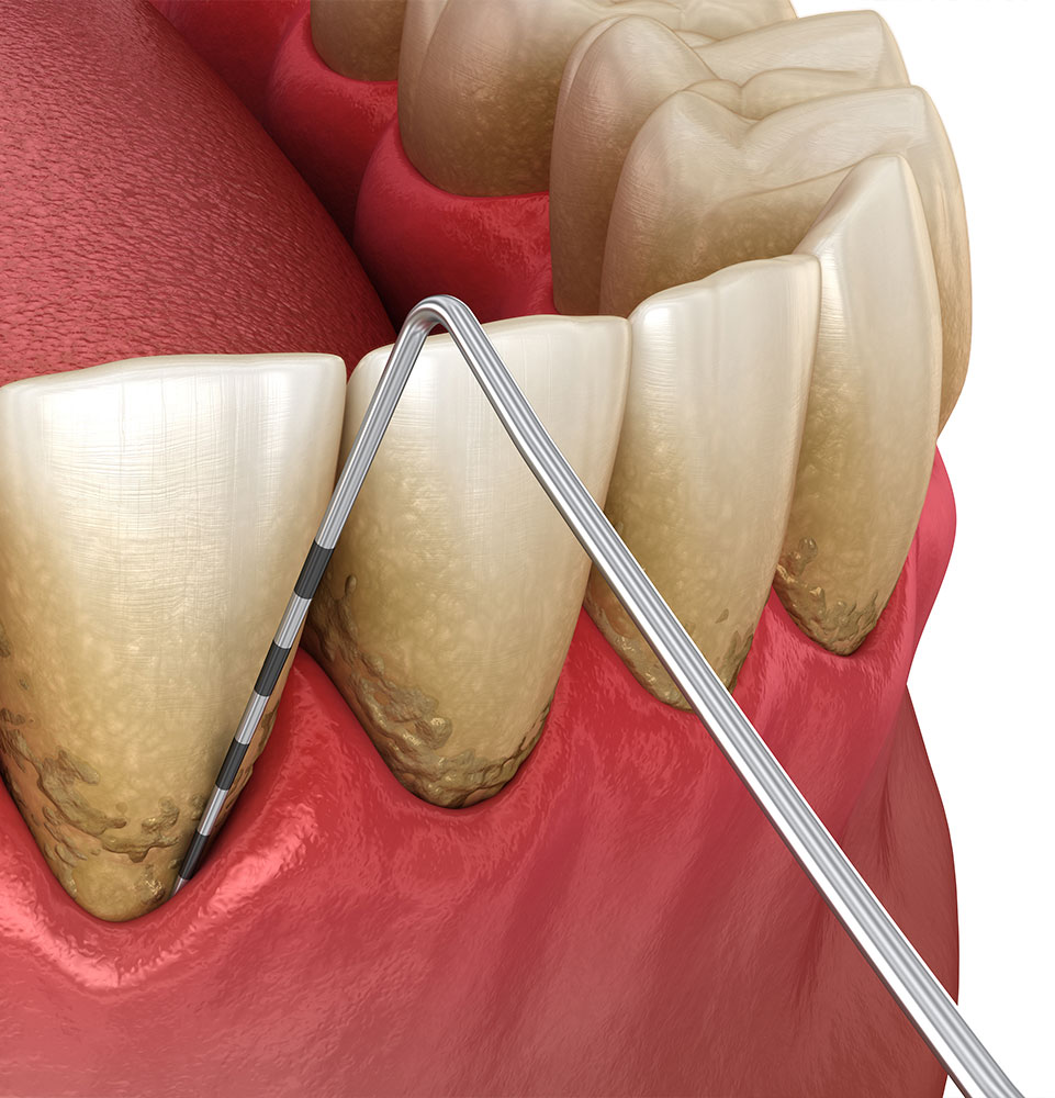 gum disease
