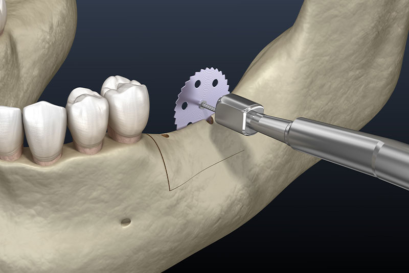 ridge augmentation
