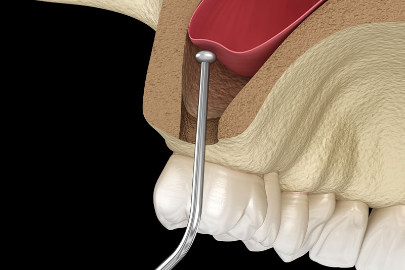 sinus lifts