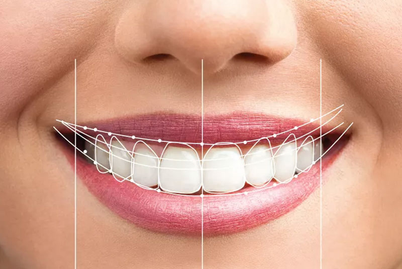 smile design preview