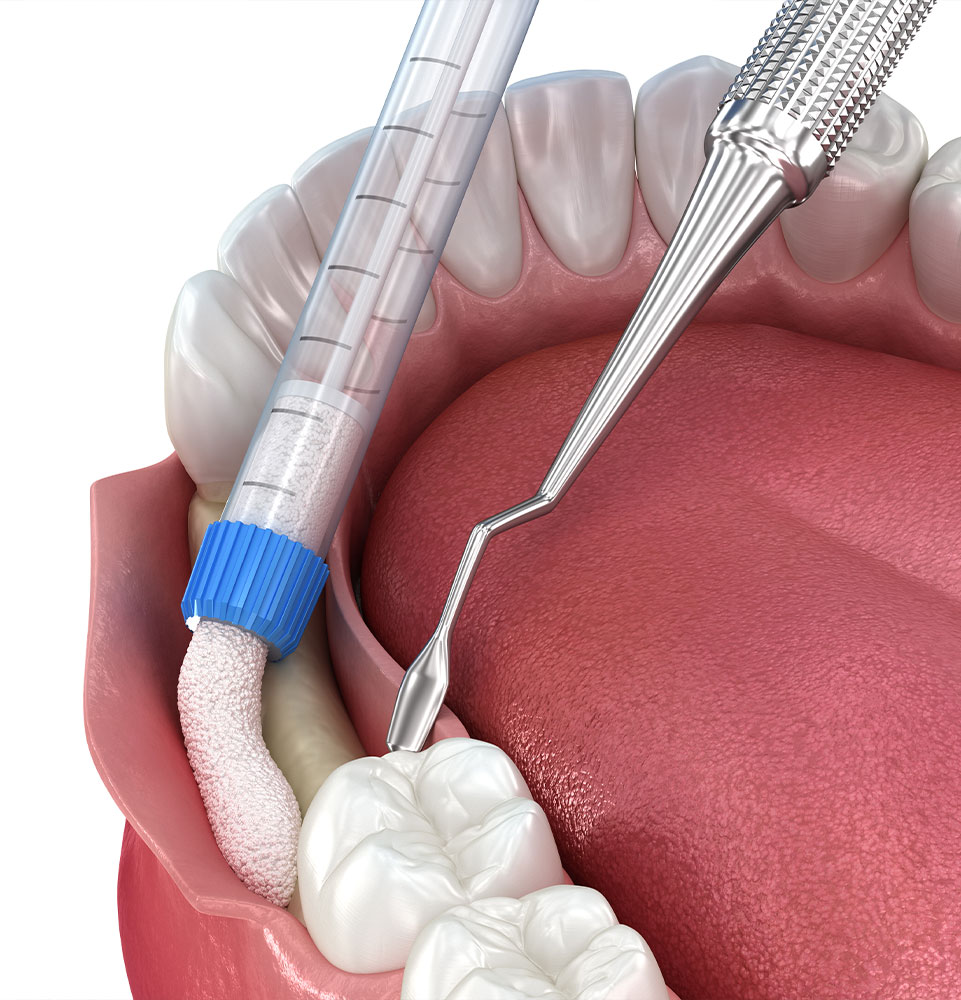 bone grafting 3d render