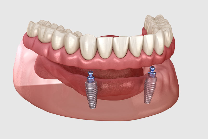 implant supported dentures