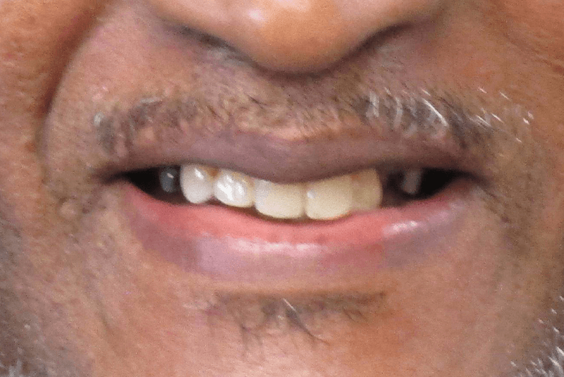 close up of patient before procedure