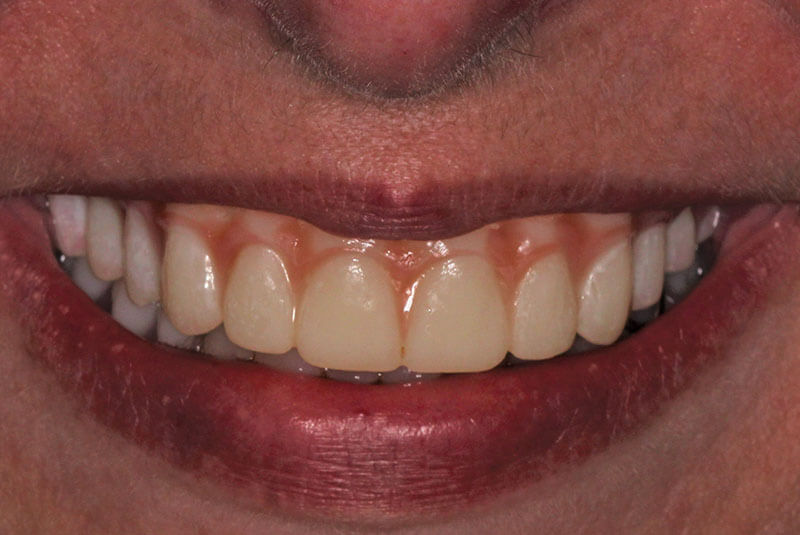 after procedure close up of patient