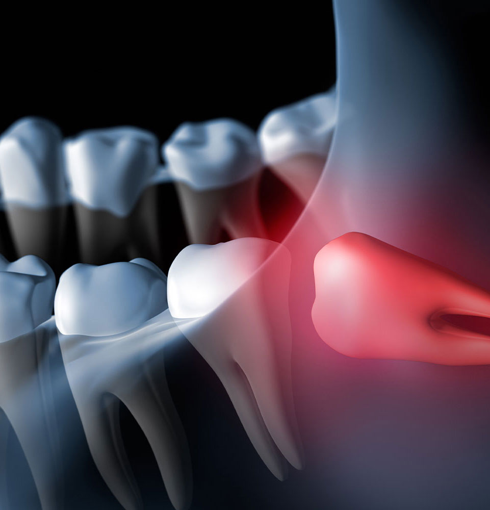 Tooth Extraction Graphic For Impacted Wisdom Tooth