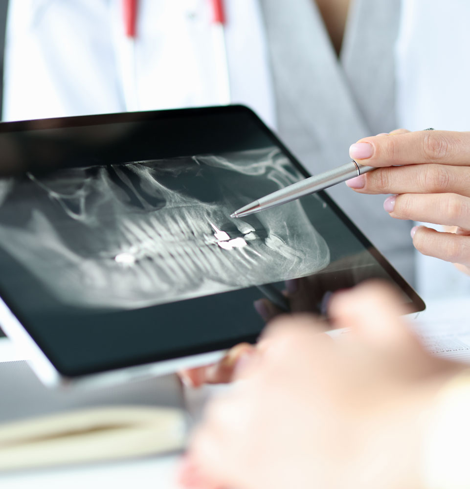 Tooth Extraction Consult X-Ray