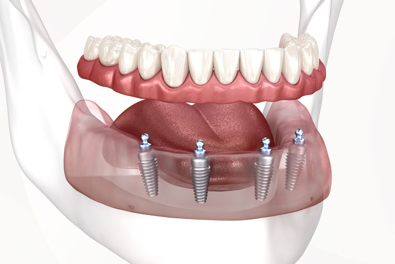 implant supported denture model