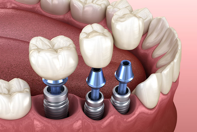 dental implants 3d render