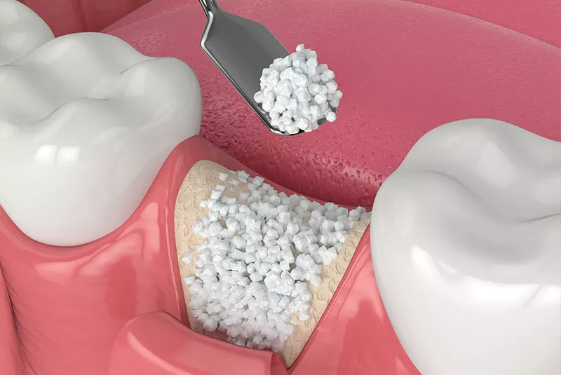 Bone Graft Illustration