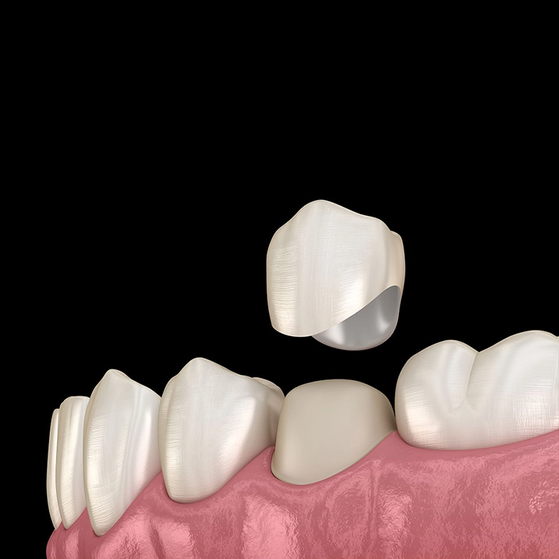 CEREC Same Day Crown Illustration