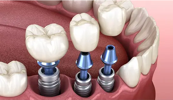 Dental Implants Illustration