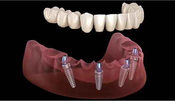 Full Mouth Dental Implants Illustration