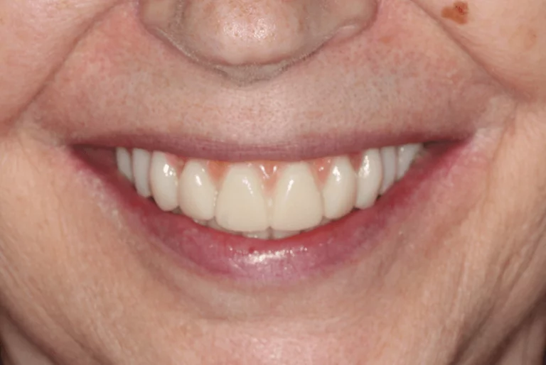 Full Mouth Dental Implants Patient 1 After