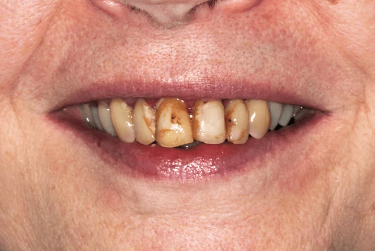 Full Mouth Dental Implants Patient 1 Before