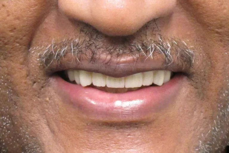 Full Mouth Dental Implants Patient 2 After