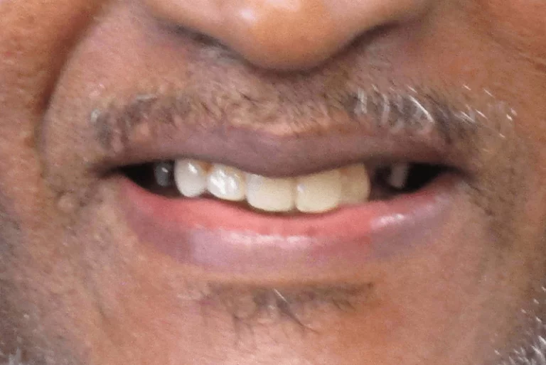 Full Mouth Dental Implants Patient 2 Before