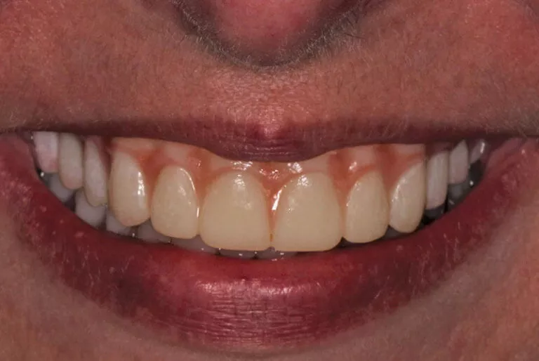 Full Mouth Dental Implants Patient 3 After