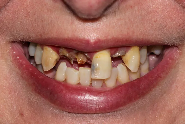 Full Mouth Dental Implants Patient 3 Before