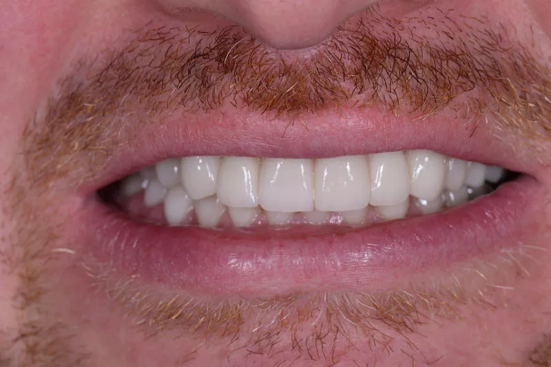 Full Mouth Dental Implants Patient 4 After