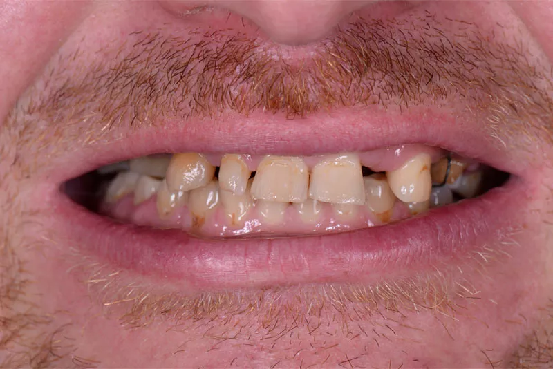 Full Mouth Dental Implants Patient 4 Before