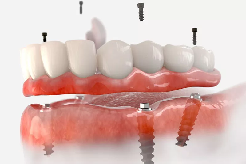 Full Mouth Dental Implants Model