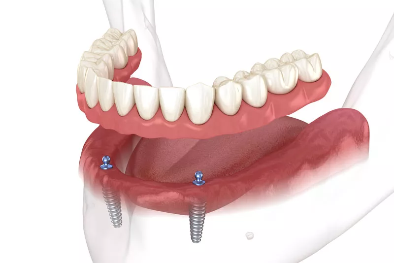 Implant Supported Dentures Model