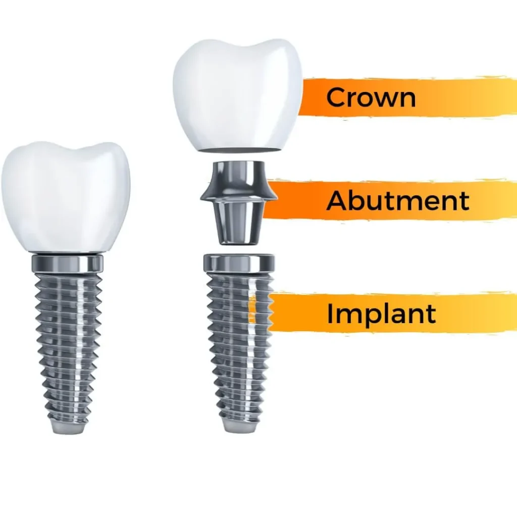 Anatomy of a Dental Implant