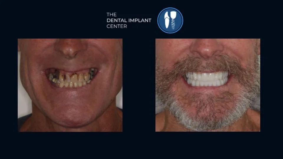 Dental Implants Before and After