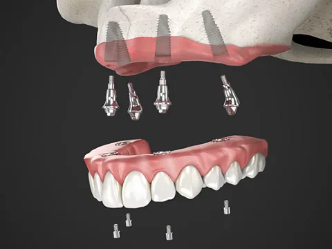 Dental Implant Model