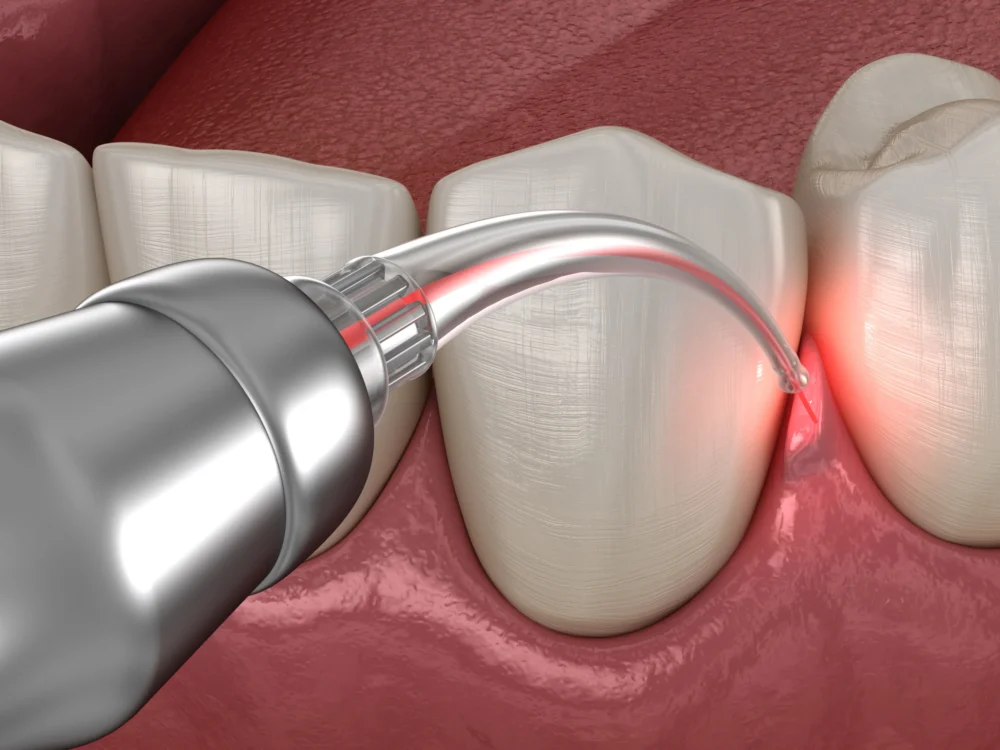 LANAP Gum Disease Treatment Model